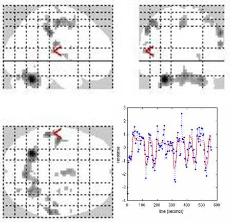 Screenshot from analysis program called SPM is showing map of brain and hemodynamic response for a selected voxel